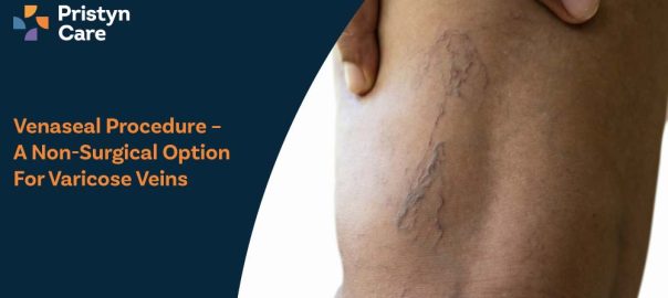 Venaseal Procedure – A Non-Surgical Option for Varicose Veins
