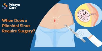When-Does-a-Pilonidal-Sinus-Require-Surgery