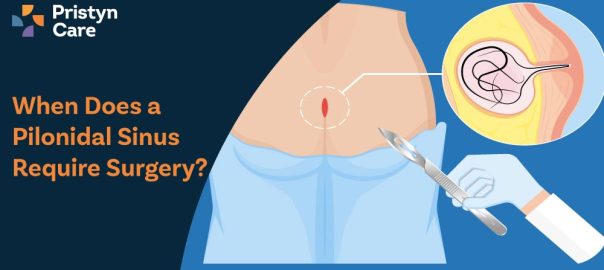 When Does a Pilonidal Sinus Require Surgery?