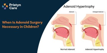 When Is Adenoid Surgery Necessary in Children?