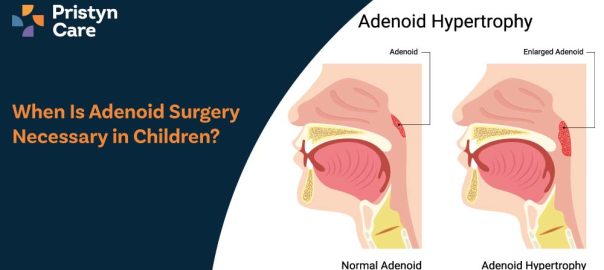 When Is Adenoid Surgery Necessary in Children?