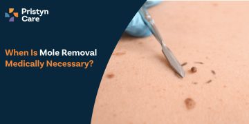 When Is Mole Removal Medically Necessary?