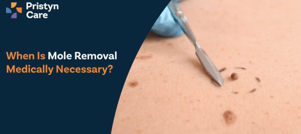 When Is Mole Removal Medically Necessary?