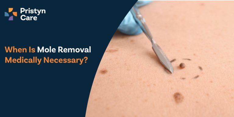 When Is Mole Removal Medically Necessary?
