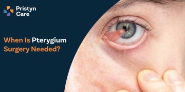 When Is Pterygium Surgery Needed?