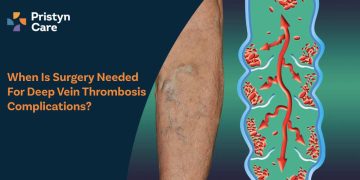 When Is Surgery Needed for Deep Vein Thrombosis Complications?