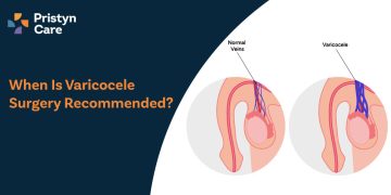 When Is Varicocele Surgery Recommended?