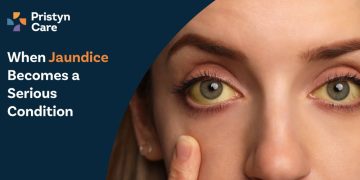 When Jaundice Becomes a Serious Condition