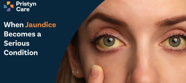 When Jaundice Becomes a Serious Condition