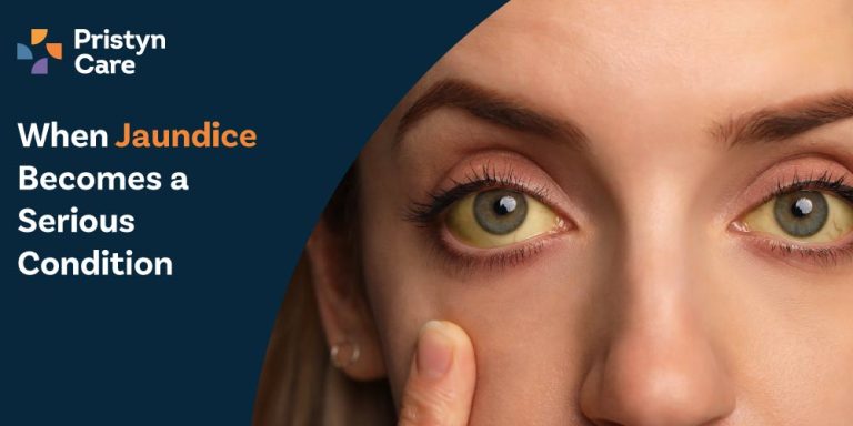When Jaundice Becomes a Serious Condition
