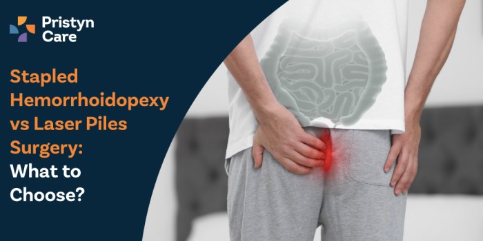Stapled-Hemorrhoidopexy-vs-Laser-Piles-Surgery-–-What-to-Choose