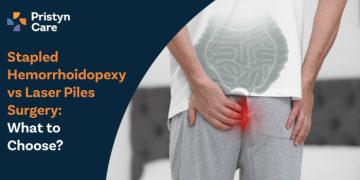 Stapled-Hemorrhoidopexy-vs-Laser-Piles-Surgery-–-What-to-Choose