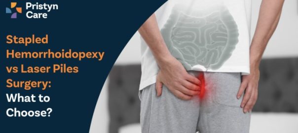 Stapled Hemorrhoidopexy vs Laser Piles Surgery – What to Choose?
