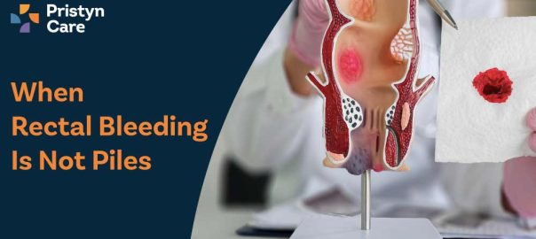When Rectal Bleeding Is Not Piles