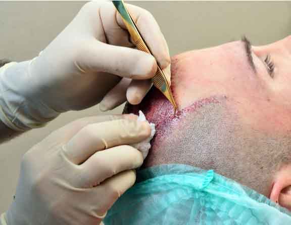 Celebrities who underwent hair transplant