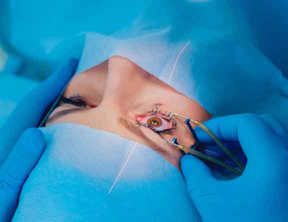 Lasik eye surgery 
