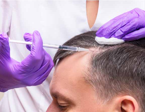 Treating hair fall by PRP injection