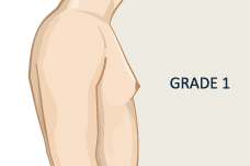 Gynecomastia Surgery