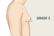 Grade 2 Gynecomastia Surgery