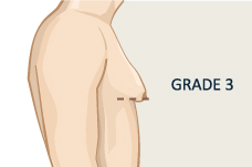 Grade 3 Gynecomastia Surgery