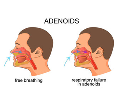 formation of Adenoidectomy