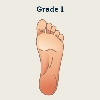 Grade 1- Intact Skin