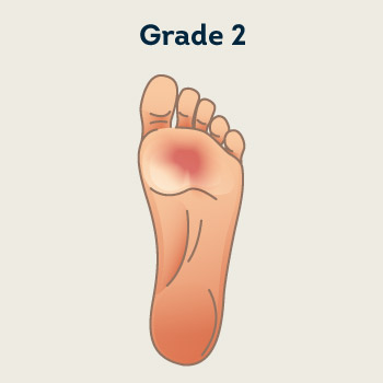 Grade 2- Superficial Ulcer of Skin or Subcutaneous Tissue