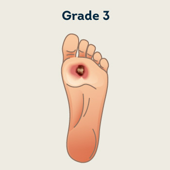 Grade 3- Ulcers Extension into Tendon, Bone, and Capsule  