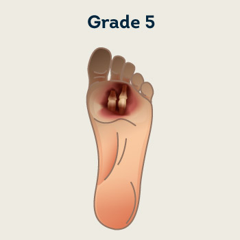 Grade V:Partial foot gangrene