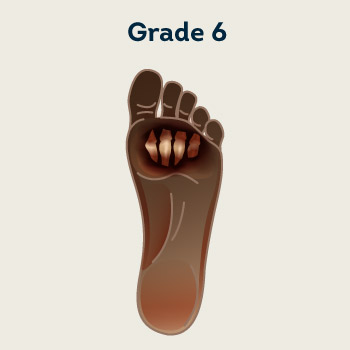 Grade 6- Whole foot gangrene