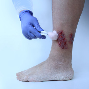 Diabetic Foot Ulcer