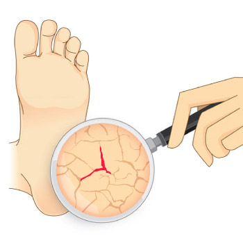 Self-diagnosis of Diabetic Foot Ulcer