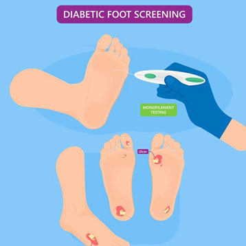 Test of Diabetic Foot Ulcer