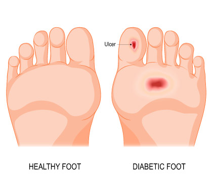 Diabetic Foot Ulcer  formation