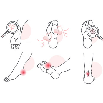 Prevention of Diabetic Foot Ulcer