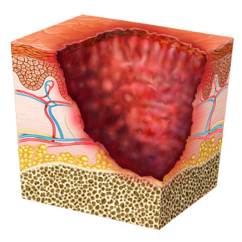 Latest Research of Diabetic Foot Ulcer 