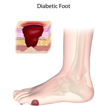 Latest Research of Diabetic Foot Ulcer 