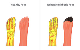 Ischemic Ulcers- It occurs when the peripheral artery disease is present without diabetic peripheral neuropathy. 
