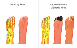 Neuroischemic Ulcers- It occurs when both peripheral neuropathy and ischemia are present as a result of peripheral artery disease. 