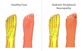 Neuropathic Ulcers- It occurs in the case of peripheral diabetic neuropathy. 