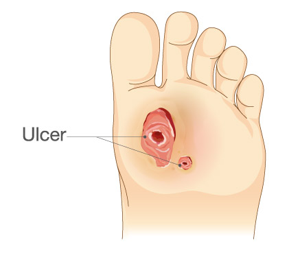 Diabetic Foot Ulcer 