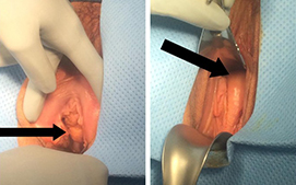 Vaginal Cyst - Causes, Symptoms, Diagnosis and Treatment