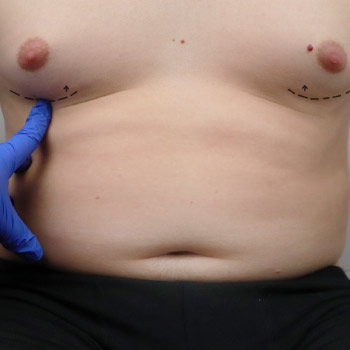 Latest Research of Gynecomastia Surgery