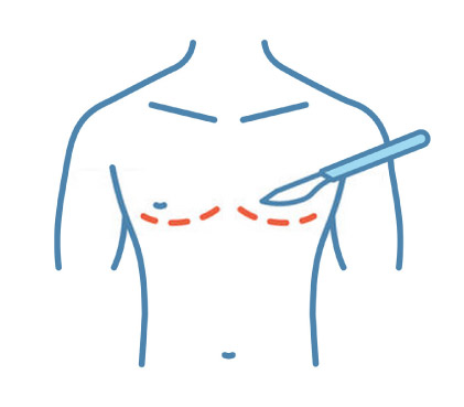 Gynecomastia Surgery