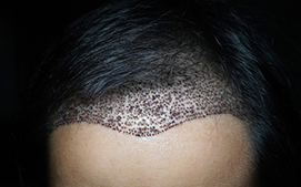 Direct Hair Implantation (DHI)