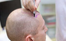 Follicular Unit Strip Surgery (FUSS) 