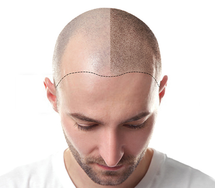 Hair Fall/Loss - Reasons, Procedure, Cost, Risks, Recovery Hair Fall/Loss - Reasons, Procedure, Cost, Risks, Recovery
