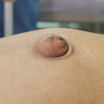 Grade I - Formation of a lump around the abdomen