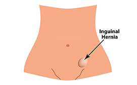 Inguinal hernia