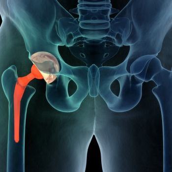 Latest research about hip Replacement
